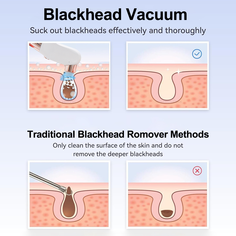 Электрический вакуумный очисти – обзор и цена Pore Vacuum