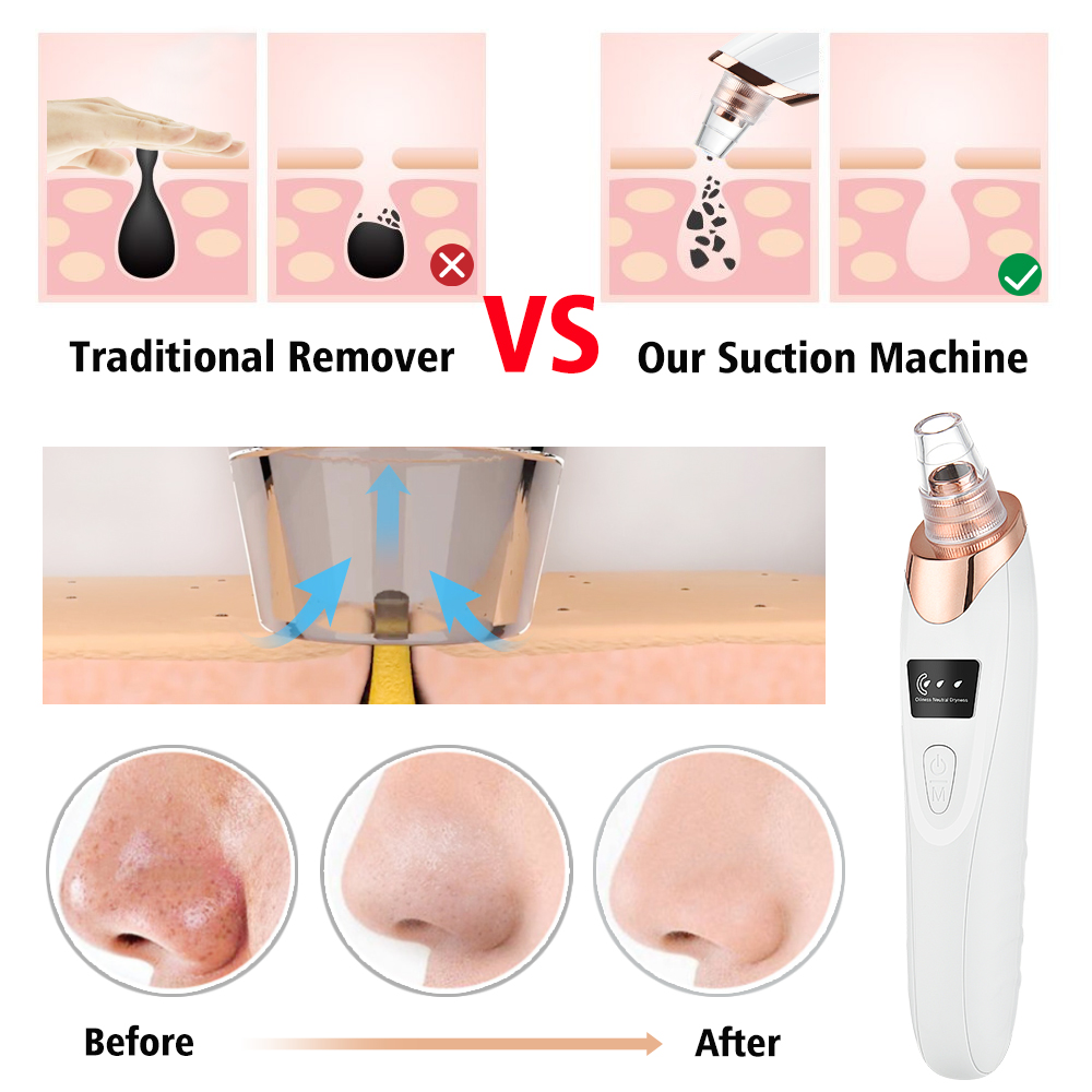Средство для удаления черных т – обзор и цена Pore Vacuum